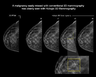 3d mammography scan