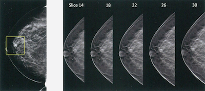 2D vs. 3D Breast Imaging