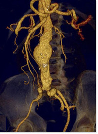 Abdominal Aortic Aneurysm