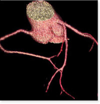 Coronary Artery CTA