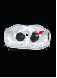 Lung Cancer Screening