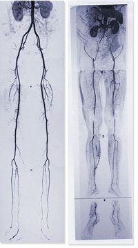 Peripheral Vascular Disease