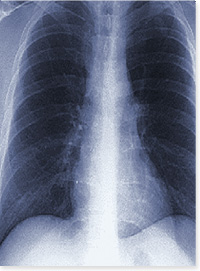 X-ray