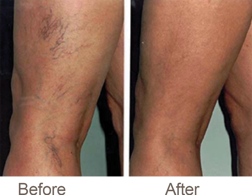 Before and after sclerotherapy