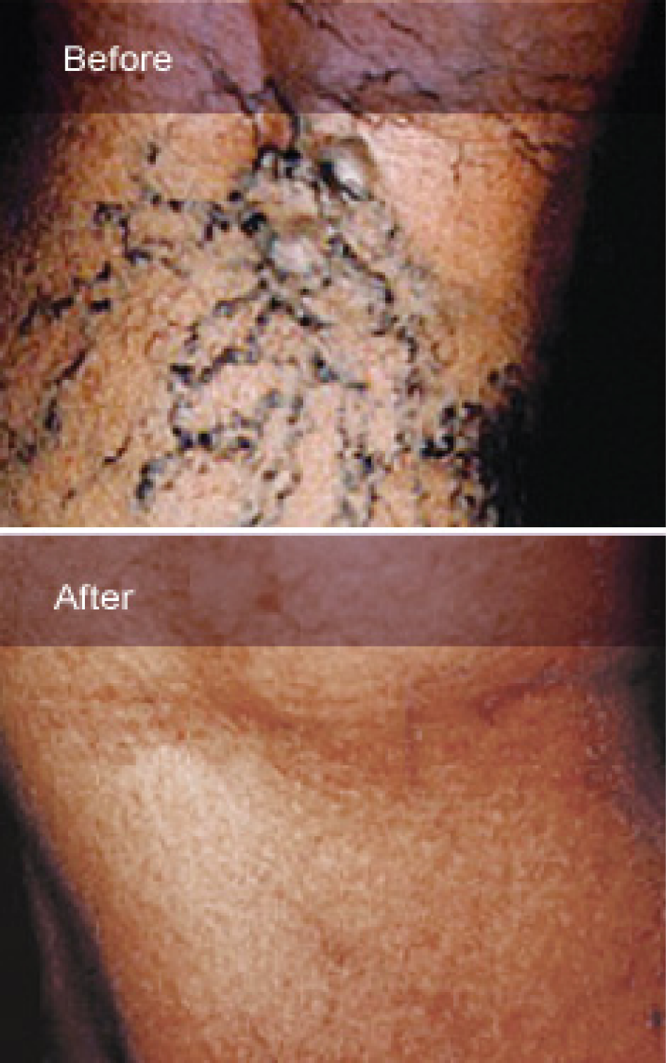 Spider Veins - Before and After